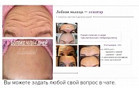 Результаты процедуры,,Ботокс лба,,