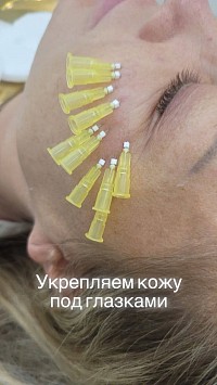 Периорбитальная область Mononiti 27G/25mm